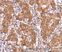 Immunohistochemistry of paraffin-embedded Human gastric cancer tissue using AMER1 Polyclonal Antibody at dilution 1:40