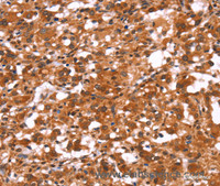 Immunohistochemistry of paraffin-embedded Human thyroid cancer using GABAA Receptor alpha1 Polyclonal Antibody at dilution of 1:30