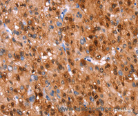 Immunohistochemistry of paraffin-embedded Human liver cancer using GH1 Polyclonal Antibody at dilution of 1:40