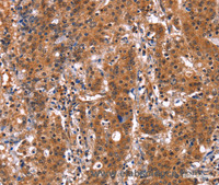 Immunohistochemistry of paraffin-embedded Human gastric cancer using GUK1 Polyclonal Antibody at dilution of 1:50