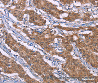 Immunohistochemistry of paraffin-embedded Human gasrtic cancer tissue using Histamine H3 Receptor Polyclonal Antibody at dilution 1:40