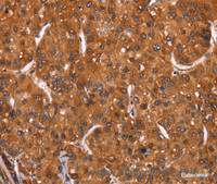 Immunohistochemistry of paraffin-embedded Human liver cancer tissue using HRK Polyclonal Antibody at dilution 1:40