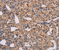 Immunohistochemistry of paraffin-embedded Human prostate cancer tissue using IL12RB2 Polyclonal Antibody at dilution 1:40