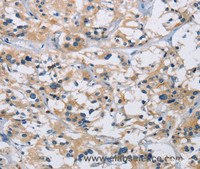 Immunohistochemistry of paraffin-embedded Human thyroid cancer using IL17RB Polyclonal Antibody at dilution of 1:40