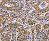 Immunohistochemistry of paraffin-embedded Human gasrtic cancer tissue using IPO8 Polyclonal Antibody at dilution 1:50