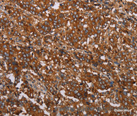 Immunohistochemistry of paraffin-embedded Human liver cancer tissue using MFAP5 Polyclonal Antibody at dilution 1:40