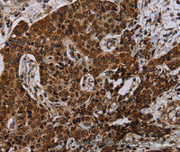 Immunohistochemistry of paraffin-embedded Human liver cancer using NDUFA4 Polyclonal Antibody at dilution of 1:40