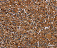 Immunohistochemistry of paraffin-embedded Human prostate cancer using NDUFA8 Polyclonal Antibody at dilution of 1:40