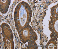 Immunohistochemistry of paraffin-embedded Human colon cancer tissue using NEFH Polyclonal Antibody at dilution 1:40