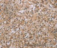 Immunohistochemistry of paraffin-embedded Human prostate cancer tissue using RAB39B Polyclonal Antibody at dilution 1:45