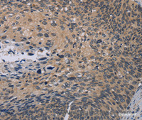 Immunohistochemistry of paraffin-embedded Human cervical cancer tissue using NOX1 Polyclonal Antibody at dilution 1:50