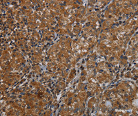 Immunohistochemistry of paraffin-embedded Human thyroid cancer tissue using IVL Polyclonal Antibody at dilution 1:50