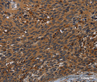 Immunohistochemistry of paraffin-embedded Human cervical cancer tissue using PCDHB15 Polyclonal Antibody at dilution 1:50