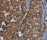 Immunohistochemistry of paraffin-embedded Human breast cancer tissue using PDE5A Polyclonal Antibody at dilution 1:50