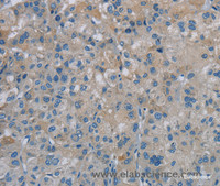 Immunohistochemistry of paraffin-embedded Human liver cancer tissue using PGLYRP1 Polyclonal Antibody at dilution 1:40