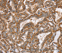 Immunohistochemistry of paraffin-embedded Human thyroid cancer using PPOX Polyclonal Antibody at dilution of 1:40