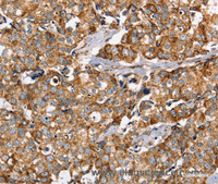 Immunohistochemistry of paraffin-embedded Human breast cancer using PPOX Polyclonal Antibody at dilution of 1:40