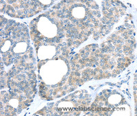 Immunohistochemistry of paraffin-embedded Human thyroid cancer tissue using RAB24 Polyclonal Antibody at dilution 1:45