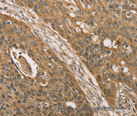 Immunohistochemistry of paraffin-embedded Human esophagus cancer using KDM5A Polyclonal Antibody at dilution of 1:45