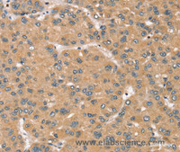 Immunohistochemistry of paraffin-embedded Human liver cancer tissue using RBM38 Polyclonal Antibody at dilution 1:45