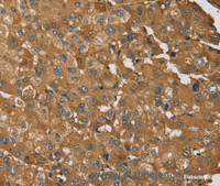 Immunohistochemistry of paraffin-embedded Human liver cancer using RNF5 Polyclonal Antibody at dilution of 1:35