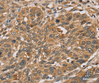 Immunohistochemistry of paraffin-embedded Human lung cancer using RNF5 Polyclonal Antibody at dilution of 1:35