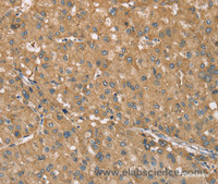 Immunohistochemistry of paraffin-embedded Human liver cancer tissue using RNF148 Polyclonal Antibody at dilution 1:40