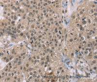 Immunohistochemistry of paraffin-embedded Human breast cancer using ACTN2 Polyclonal Antibody at dilution of 1:30