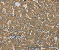 Immunohistochemistry of paraffin-embedded Human thyroid cancer using SDHB Polyclonal Antibody at dilution of 1:30