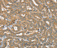 Immunohistochemistry of paraffin-embedded Human thyroid cancer using SEC14L2 Polyclonal Antibody at dilution of 1:40