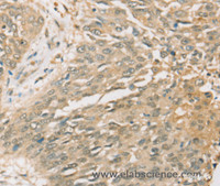 Immunohistochemistry of paraffin-embedded Human lung cancer tissue using SIGLEC15 Polyclonal Antibody at dilution 1:35