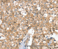Immunohistochemistry of paraffin-embedded Human breast cancer tissue using SLC6A7 Polyclonal Antibody at dilution 1:30