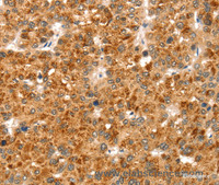 Immunohistochemistry of paraffin-embedded Human liver cancer using CCS Polyclonal Antibody at dilution of 1:35