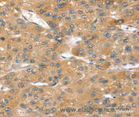 Immunohistochemistry of paraffin-embedded Human liver cancer tissue using SORT1 Polyclonal Antibody at dilution 1:40
