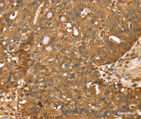Immunohistochemistry of paraffin-embedded Human breast cancer using STARD5 Polyclonal Antibody at dilution of 1:40