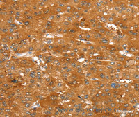Immunohistochemistry of paraffin-embedded Human liver cancer tissue using ABCC9 Polyclonal Antibody at dilution 1:50