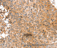 Immunohistochemistry of paraffin-embedded Human esophagus cancer tissue using ABCC9 Polyclonal Antibody at dilution 1:50