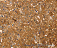 Immunohistochemistry of paraffin-embedded Human breast cancer tissue using TMSB10 Polyclonal Antibody at dilution 1:35