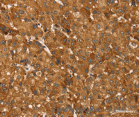 Immunohistochemistry of paraffin-embedded Human liver cancer tissue using TBC1D1 Polyclonal Antibody at dilution 1:45