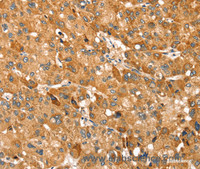 Immunohistochemistry of paraffin-embedded Human liver cancer using TRIM62 Polyclonal Antibody at dilution of 1:30