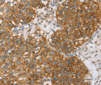 Immunohistochemistry of paraffin-embedded Human breast cancer using TPD54 Polyclonal Antibody at dilution of 1:35