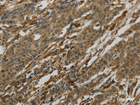 Immunohistochemistry of paraffin-embedded Human gastric cancer tissue using AIF1 Polyclonal Antibody at dilution 1:50