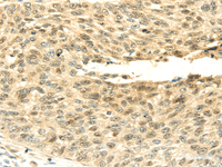 Immunohistochemistry of paraffin-embedded Human lung cancer tissue using SHPRH Polyclonal Antibody at dilution 1:45