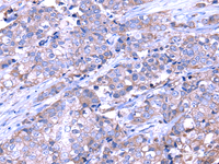 Immunohistochemistry of paraffin-embedded Human breast cancer tissue using SRPK1 Polyclonal Antibody at dilution 1:35