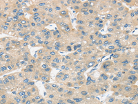 Immunohistochemistry of paraffin-embedded Human liver cancer tissue using TIRAP Polyclonal Antibody at dilution 1:30