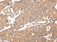 Immunohistochemistry of paraffin-embedded Human prostate cancer using ALDH3A2 Polyclonal Antibody at dilution of 1/20