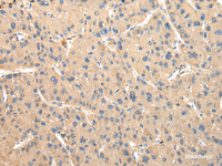 Immunohistochemistry of paraffin-embedded Human liver cancer tissue using DUSP11 Polyclonal Antibody at dilution 1:50