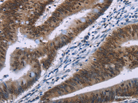 Immunohistochemistry of paraffin-embedded Human colon cancer tissue using HMGA1 Polyclonal Antibody at dilution 1:30