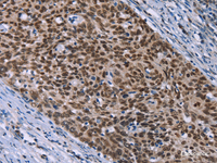 Immunohistochemistry of paraffin-embedded Human cervical cancer tissue using HMGA1 Polyclonal Antibody at dilution 1:30