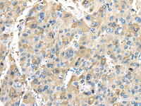 Immunohistochemistry of paraffin-embedded Human liver cancer tissue using INHBB Polyclonal Antibody at dilution 1:45